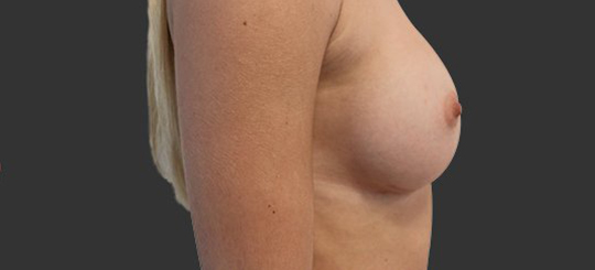 Før/Efter: Brystforstørrelse med runde mentor implantater
