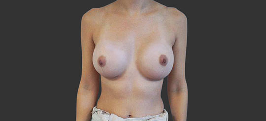 Brystforstørrende operation - efterbillede