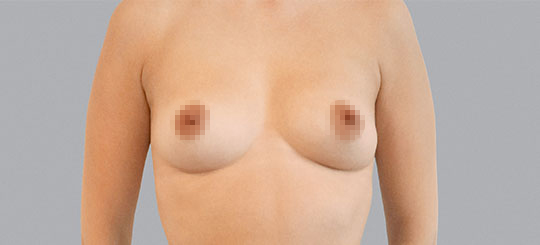 Stemform® BFO (brystforstørrelse)