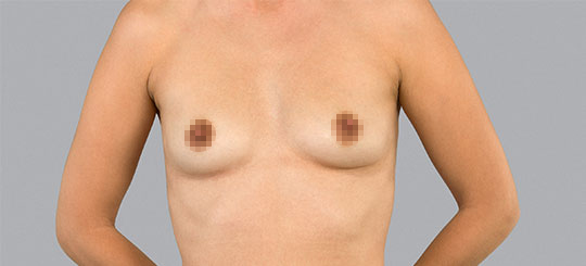 Stemform® BFO (brystforstørrelse)