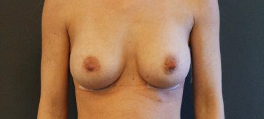 Brystforstørrelse BFO efter forfra