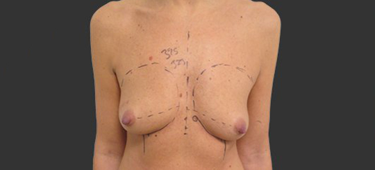 Førbillede bryster