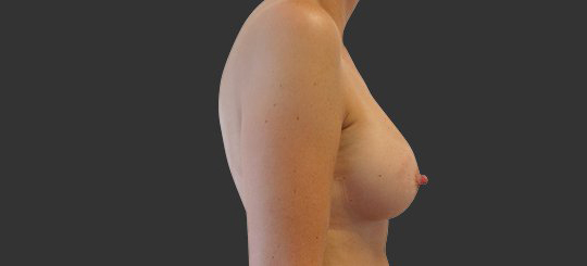 Efterbillede bryster