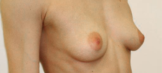 Brystforstørrelse med implantater