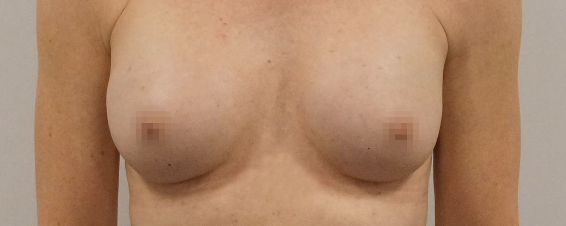Brystforstørrelse implantater