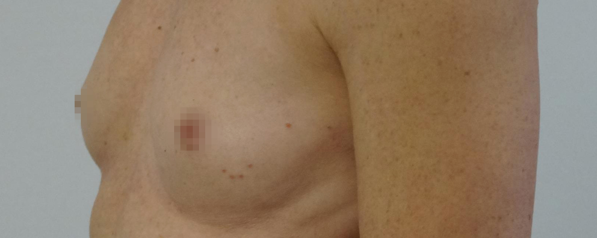 Brystforstørrelse med implantater