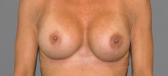 brystforstørrende operation med implantater