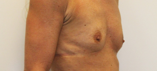 Brystforstørrende operation med implantater