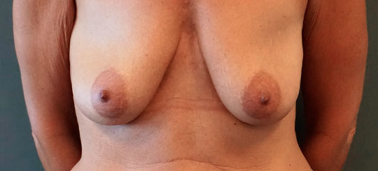 Brystløft før-billede
