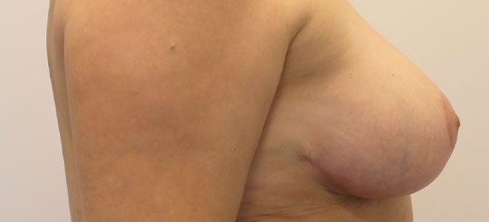Brystreduktion, før-efterbillede