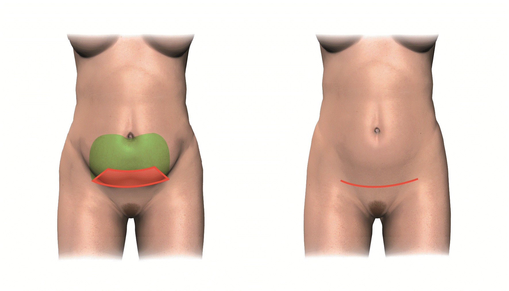 Hvad er mini-abdominalplastik?