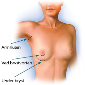 Brystimplantater – Hvor skal snittet ligge?