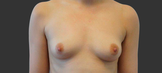 Brystforstørrende operation - førbillede