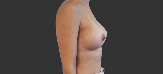 Brystforstørrende operation - efterbillede