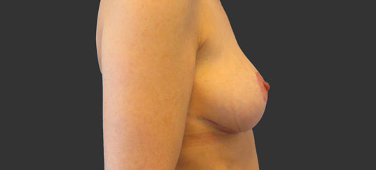 Efterbillede af bryster