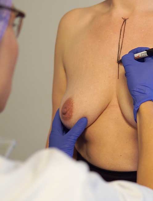 Brystforstørrende operation optegning
