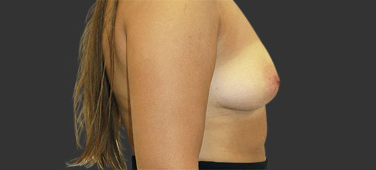 Brystforstørrende operation - førbillede