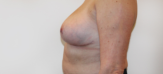 Før-efter billede af brystreduktion. Kvindes bryster i profil efter brystreduktion.