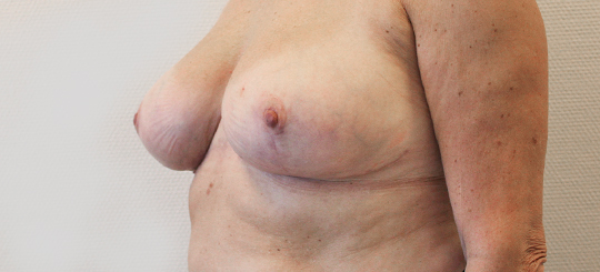 Før-efter billede af brystreduktion. Kvindes bryster skråt forfra efter brystreduktion.