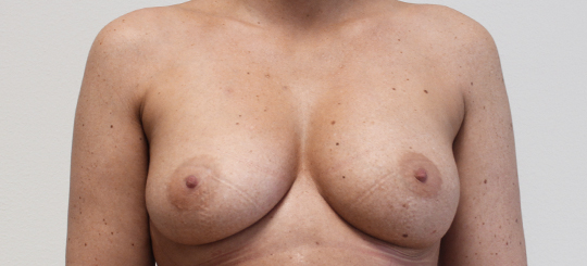 Før-efter billede: Bryster set forfra efter brystforstørrelse med eget fedt.