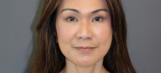 Før-efter billede af facelift. Kvindes ansigt forfra efter ansigtsløft.