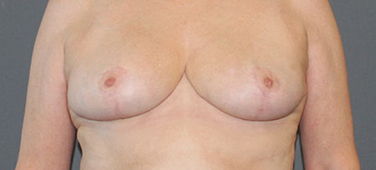 Før-efter billede af brystreduktion. Kvindes bryster forfra efter brystreduktion.