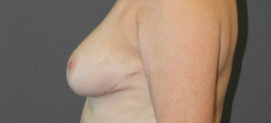 Før-efter billede af brystreduktion. Kvindes bryster i profil efter brystreduktion.