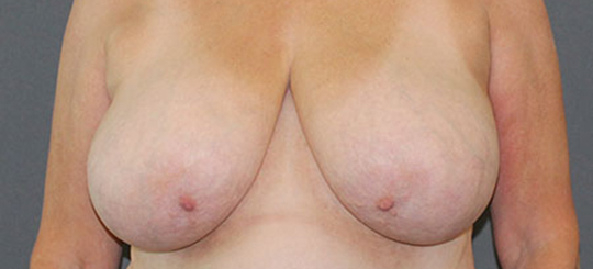 Før-efter billede af brystreduktion. Kvindes bryster forfra før brystreduktion.