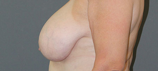 Før-efter billede af brystreduktion. Kvindes bryster i profil før brystreduktion.