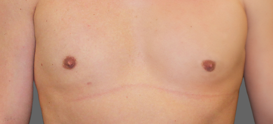 Før-efter billede af gynækomasti. Mands bryster forfra efter brystreduktion hos mand.