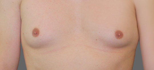 Før-efter billede af gynækomasti. Mands bryster forfra før brystreduktion hos mand.