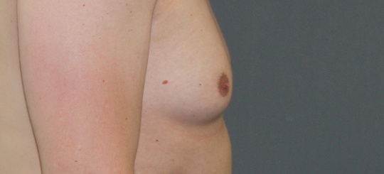 Før-efter billede af gynækomasti. Mands bryster i profil før brystreduktion hos mand.