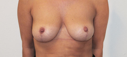 Før-efter billede af brystløft. Kvindes bryster forfra efter brystløft.