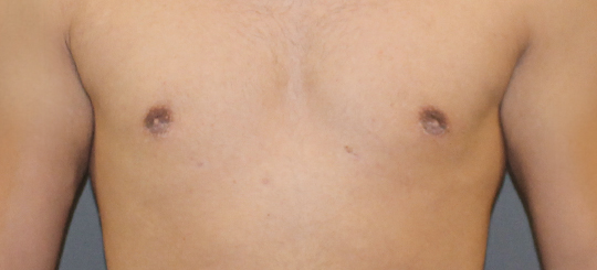 Før-efter billede af gynækomasti. Mands bryster forfra efter brystreduktion hos mand.