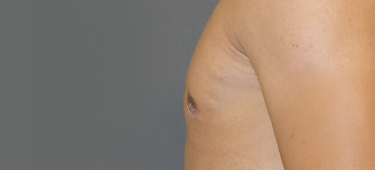 Før-efter billede af gynækomasti. Mands bryster i profil efter brystreduktion hos mand.