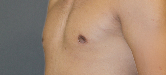 Før-efter billede af gynækomasti. Mands bryster skråt forfra efter brystreduktion hos mand.