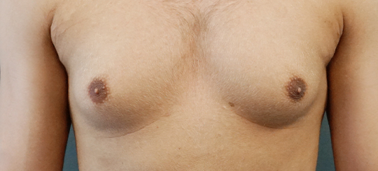 Før-efter billede af gynækomasti. Mands bryster forfra før brystreduktion hos mand.