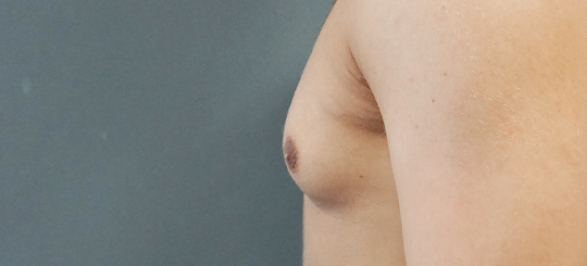 Før-efter billede af gynækomasti. Mands bryster i profil før brystreduktion hos mand.