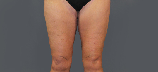 Før-efter billede af lårplastik. Kvindes lår forfra efter fjernelse af slap hud.