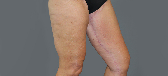 Før-efter billede af lårplastik. Kvindes lår skråt forfra efter fjernelse af slap hud.