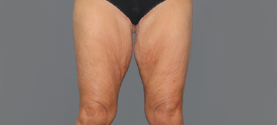 Før-efter billede af lårplastik. Kvindes lår forfra før fjernelse af slap hud.