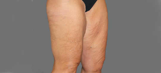 Før-efter billede af lårplastik. Kvindes lår skråt forfra før fjernelse af slap hud.