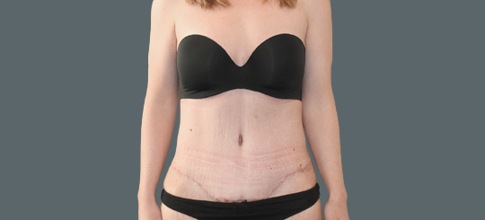 Før-efter billede af maveplastik. Kvindes mave forfra før fjernelse af slapt maveskind.