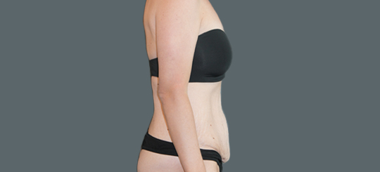 Før-efter billede af maveplastik. Kvindes mave i profil før fjernelse af slapt maveskind.