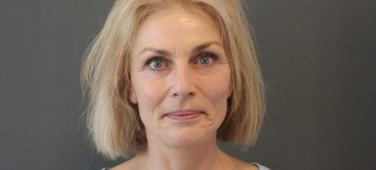 Før-efter billede af facelift. Kvindes ansigt forfra efter ansigtsløft.