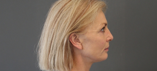 Før-efter billede af facelift. Kvindes ansigt i profil efter ansigtsløft.