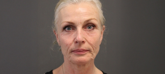 Før-efter billede af facelift. Kvindes ansigt forfra før ansigtsløft.