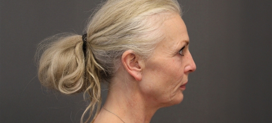 Før-efter billede af facelift. Kvindes ansigt i profil før ansigtsløft.