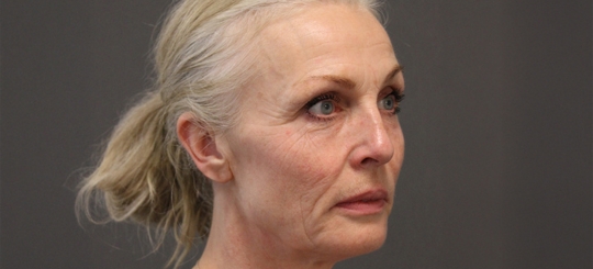 Før-efter billede af facelift. Kvindes ansigt skråt forfra før ansigtsløft.