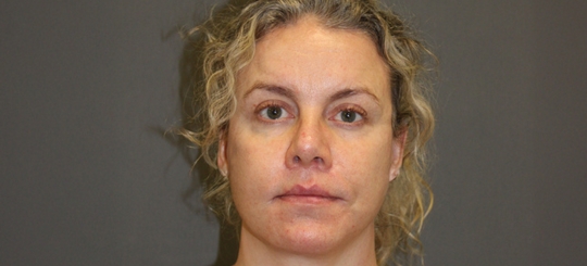 Før-efter billede af facelift. Kvindes ansigt forfra efter ansigtsløft.